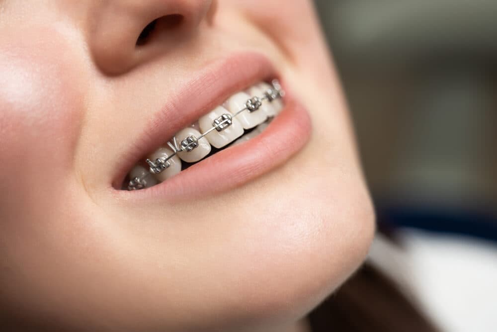 Conventional Braces treatment