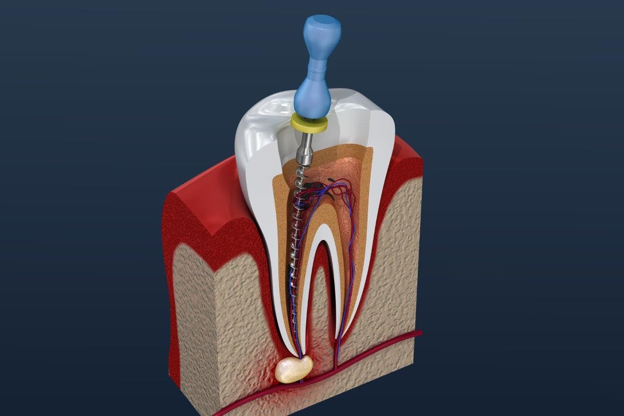 Root Canal treatment at Yes Dental Clinic