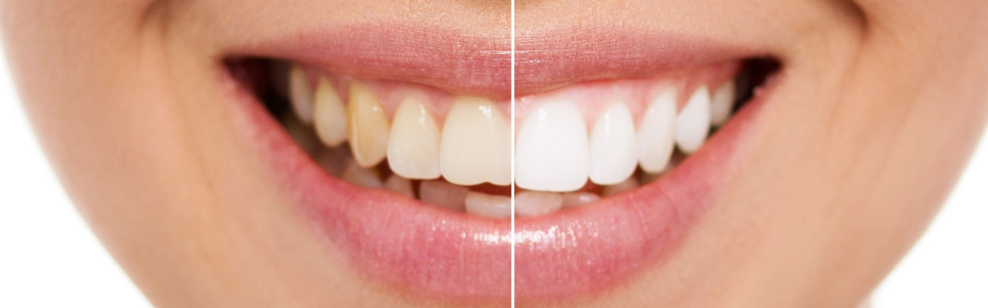 Whitening treatment